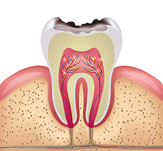 虫歯ができる理由と予防法
