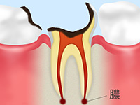 残根虫歯