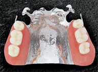 チタン製義歯